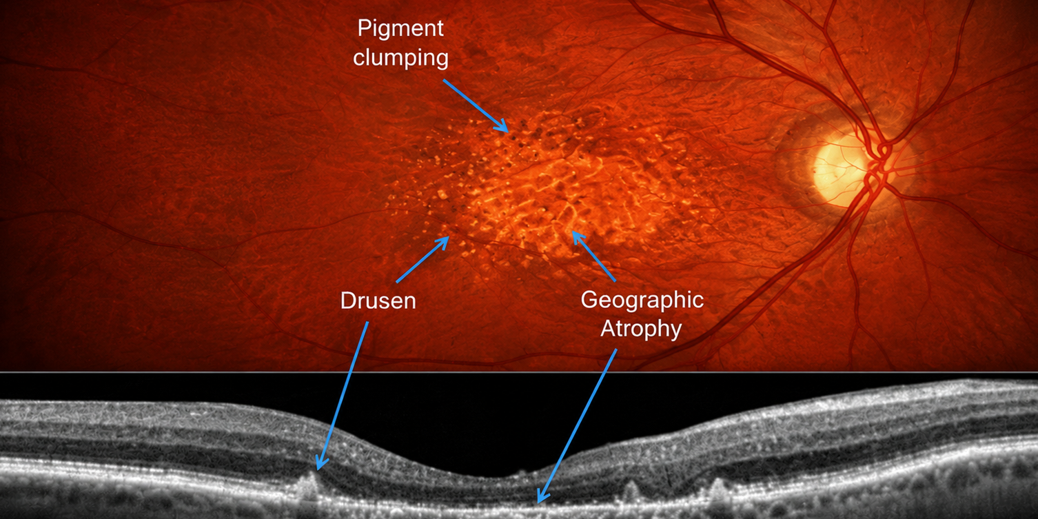Holistic Macular Degeneration Treatment