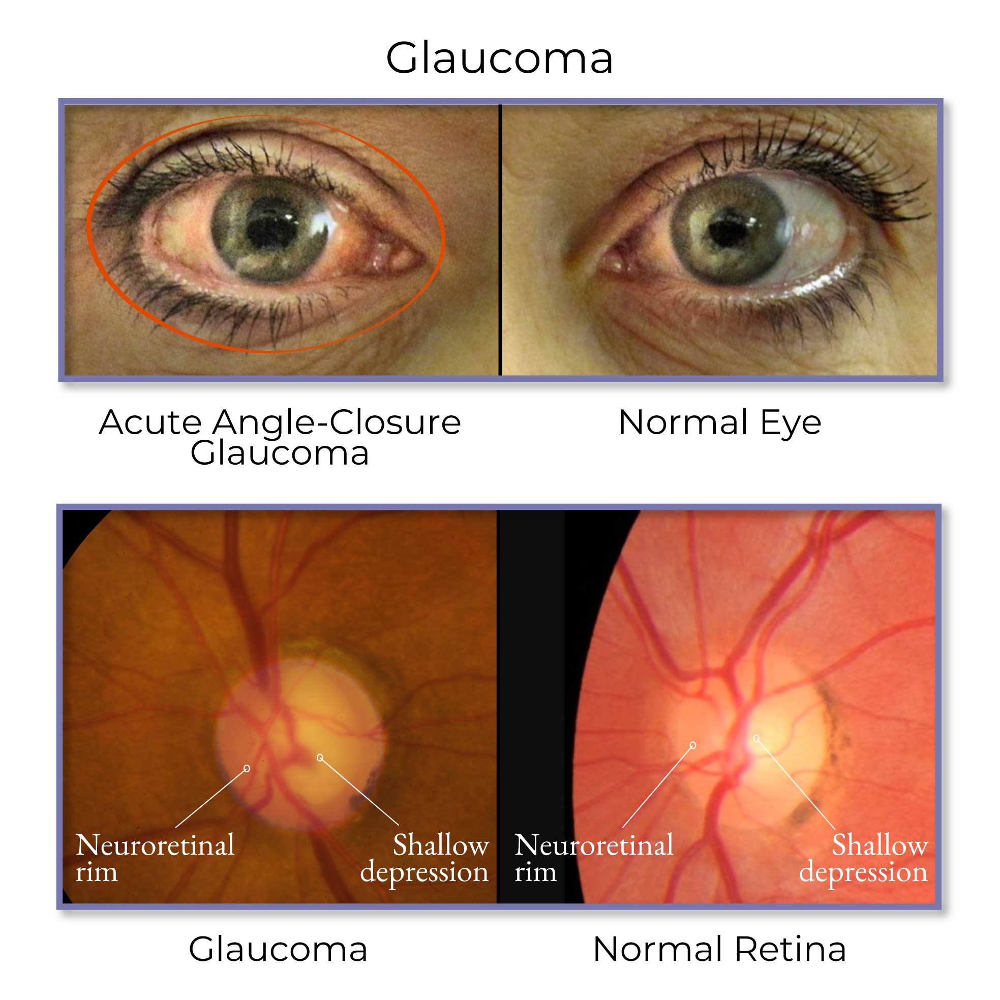 Glaucoma eye condition compared with normal eye and healthy retina