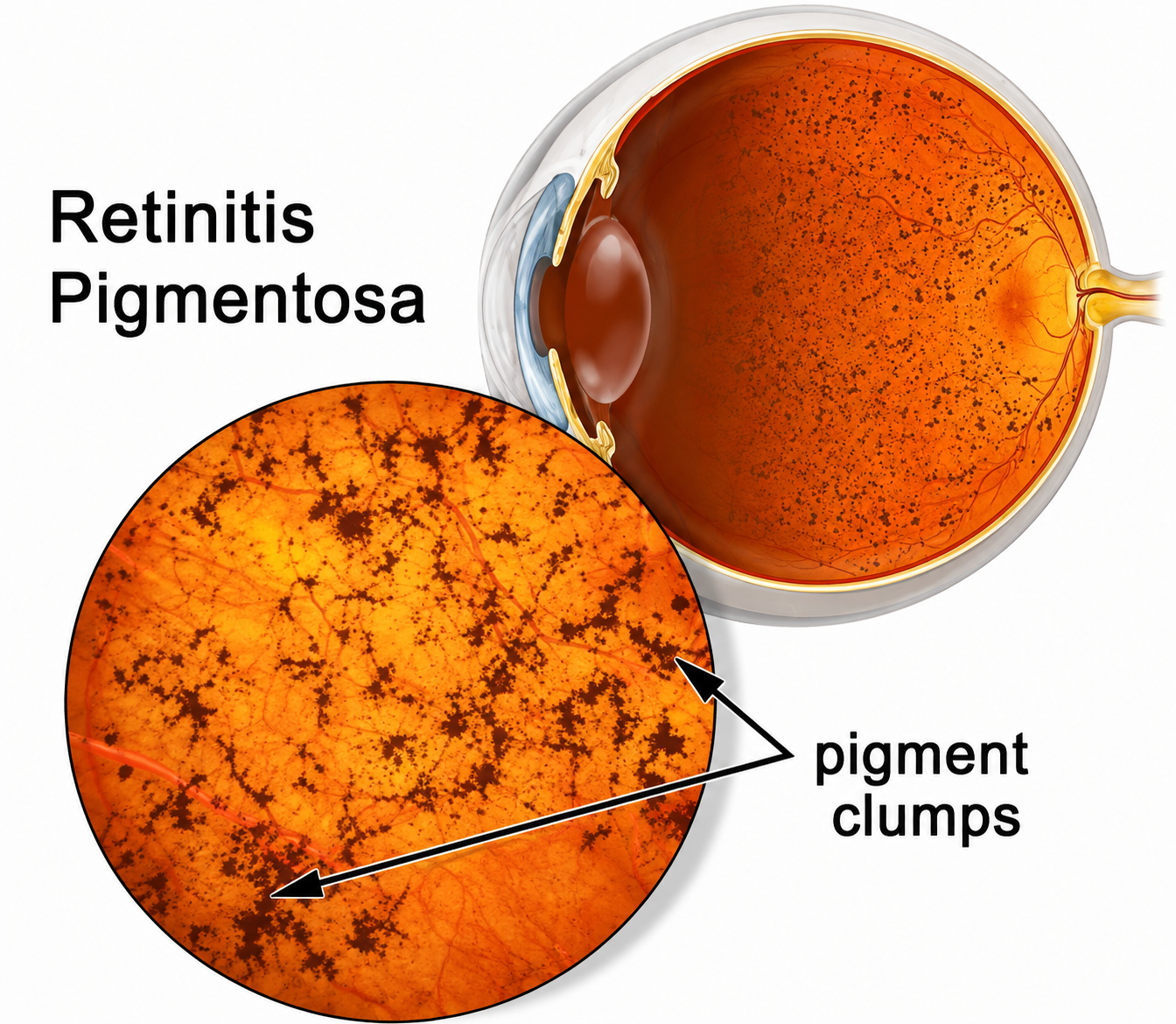 Retinitis Pigmentosa Treatment in Delhi at Acu Eye Zone