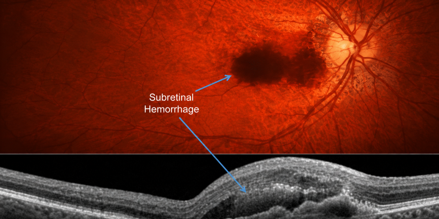 Holistic Macular Degeneration Treatment
